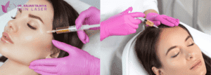 prp therapy - Dr.Rajan Tajhya | Aakar Dermatology