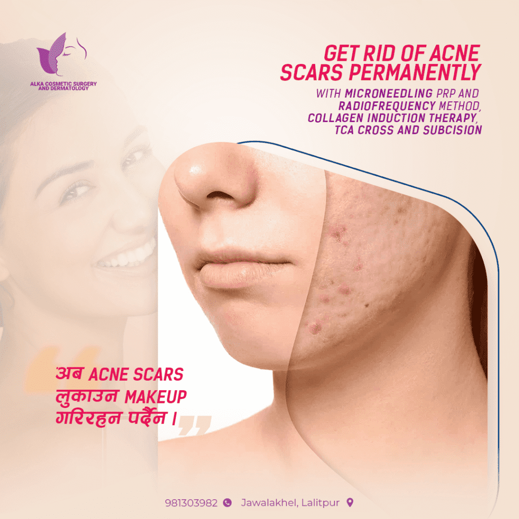Acne Scar Treatment: Types, Causes, and Solutions - Dr.Rajan Tajhya | Aakar Dermatology