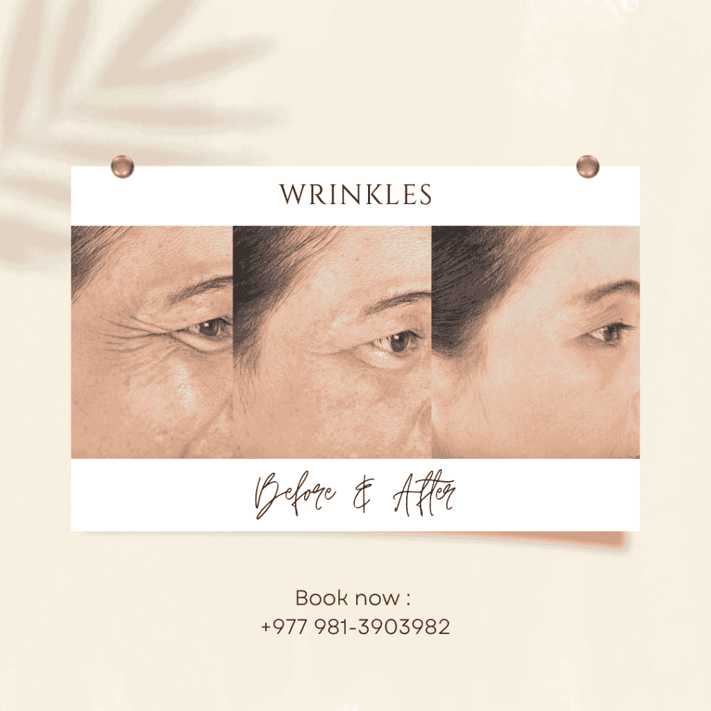 Understanding Wrinkles: Causes, Treatments, and Prevention - Dr.Rajan Tajhya | Aakar Dermatology