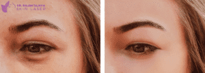 Asian Eye Lid Surgery - Dr.Rajan Tajhya | Aakar Dermatology