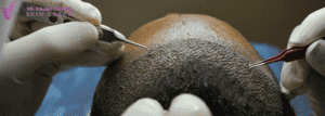hair transplant in nepal - Dr.Rajan Tajhya | Aakar Dermatology