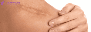 Scar Removal Revision Price in Lalitpur, Kathmandu, Nepal - Dr.Rajan Tajhya | Aakar Dermatology